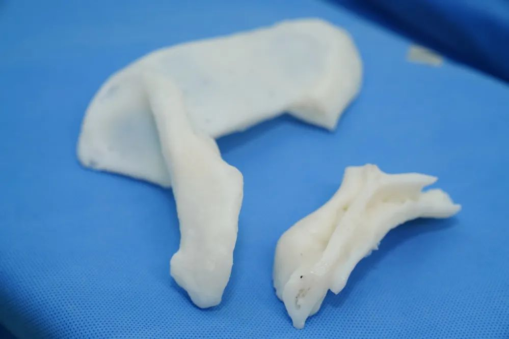 3D打印反肩置換，解決患者疑難復雜肩關(guān)節(jié)陳舊毀損傷難題